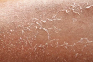 Regenerar piel deshidratada por el sol después del verano